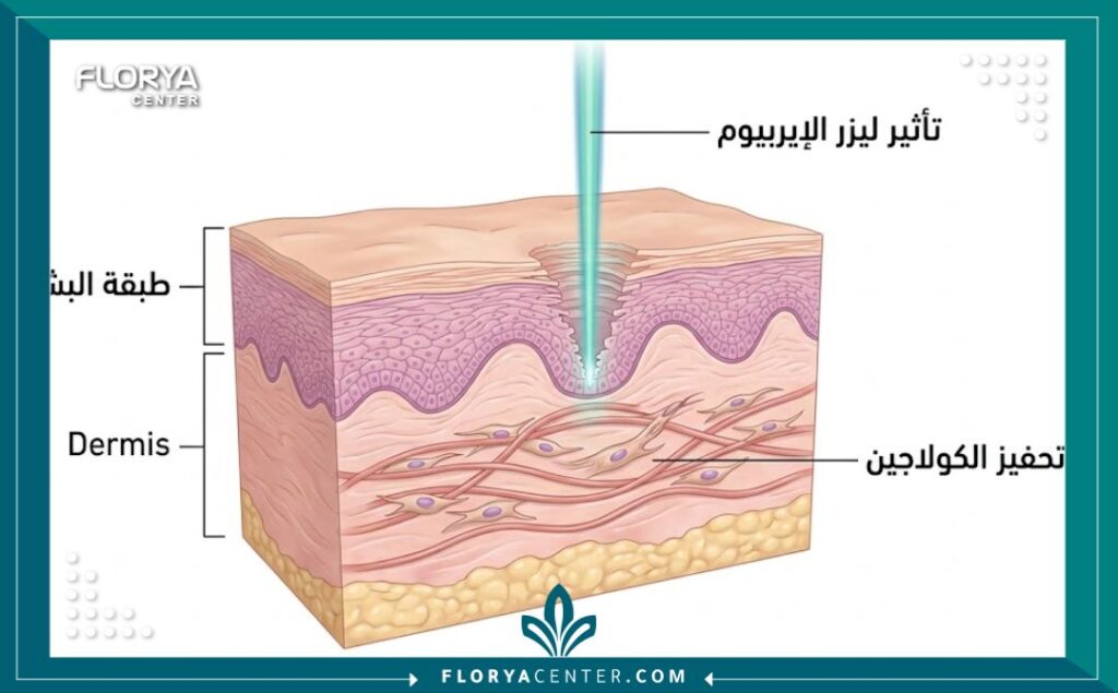 مخطط توضيحي يظهر كيفية اختراق ليزر الإيربيوم ياج لطبقات الجلد لعلاج الندبات.