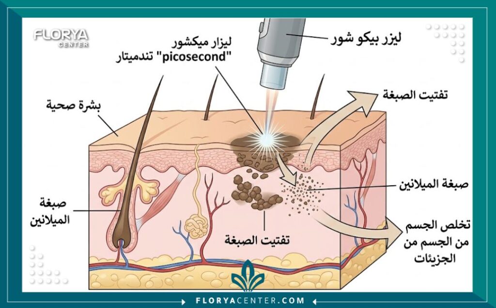 ليزر البيكو شور في تركيا 2 مخطط توضيحي طبي يظهر آلية عمل ليزر البيكو شور في تفتيت تصبغات الجلد والميلانين.