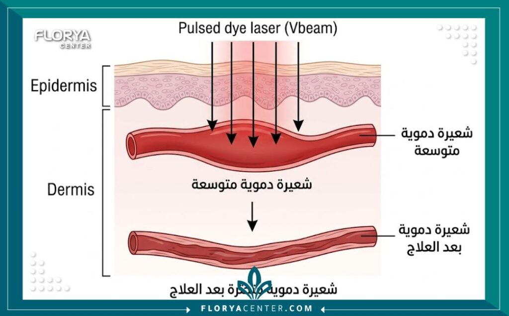 رسم توضيحي طبي لآلية عمل ليزر الفيو ليزر الفيو-بيم للشعيرات الدموية بيم في تدمير الشعيرات الدموية في الجلد