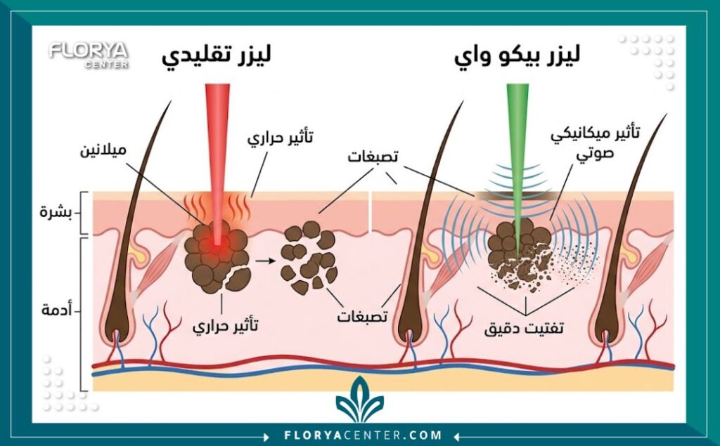 مخطط توضيحي لآلية عمل ليزر بيكو واي في تفتيت تصبغات الجلد والميلانين