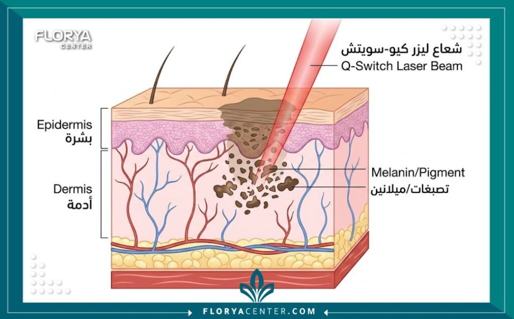 رسم تخطيطي طبي يوضح كيف يعمل ليزر كيو-سويتش على تفتيت الميلانين والتصبغات في طبقات الجلد دون إضرار الأنسجة المحيطة.