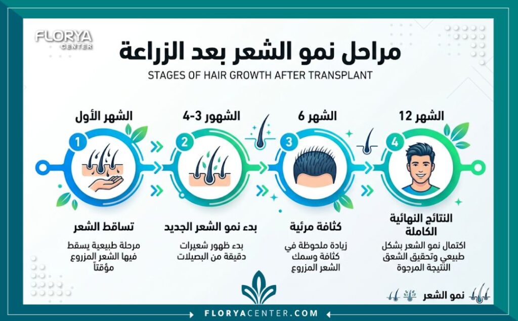 إنفوجرافيك يوضح مراحل نمو الشعر بعد الزراعة بالتفصيل على مدار 12 شهرًا حتى الوصول نتائج زراعة الشعر بعد سنة النهائية.