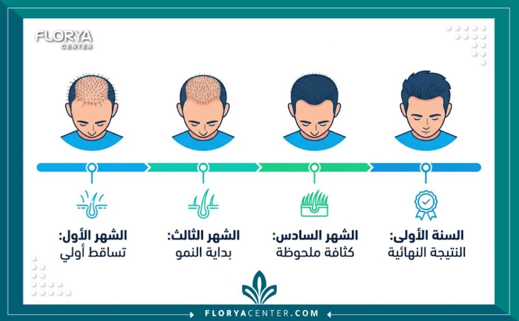 إنفوجرافيك يوضح جدول زمني لمراحل ظهور نتائج عملية زراعة الشعر المتوقعة خلال عام.