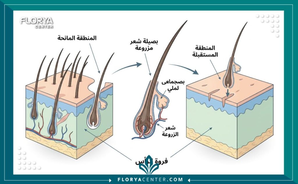 رسم تخطيطي طبي توضيحي يشرح كيفية نقل واقتطاف بصيلات الشعر في عملية زراعة الشعر للرجال.