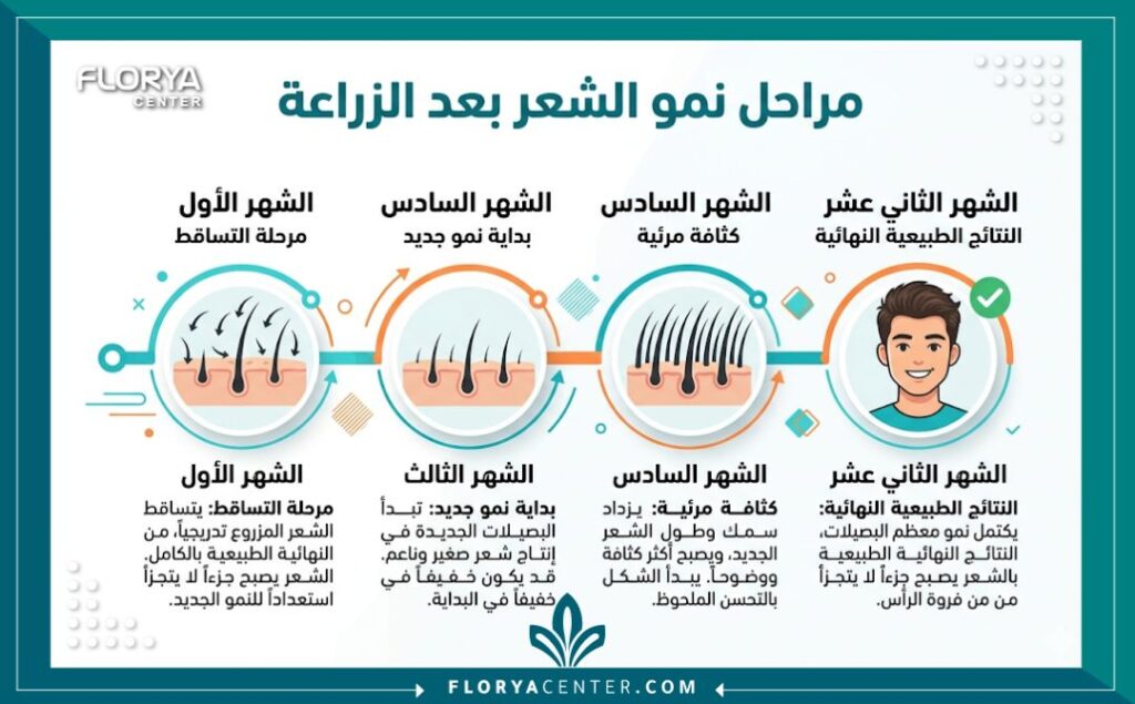 إنفوجرافيك يوضح الجدول الزمني ومراحل نمو الشعر المتوقعة شهرياً بعد نتائج وتجارب زراعة الشعر للرجال.