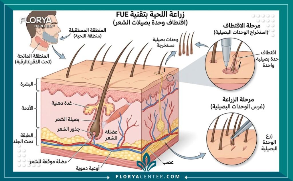 رسم تخطيطي طبي يوضح تقنية اقتطاف وحدة البصيلات (FUE) المستخدمة في زراعة شعر الذقن والشارب، وكيفية تجنب الندبات الوجهية الدائمة.