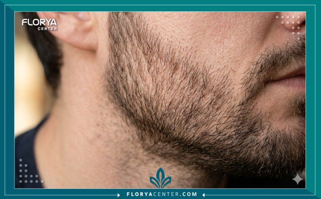 لقطة مكبرة فائقة الدقة تُظهر كثافة بصيلات الشعر المزروعة حديثاً على طول خط الفك ورأب الخد بعد عملية زراعة شعر الذقن.