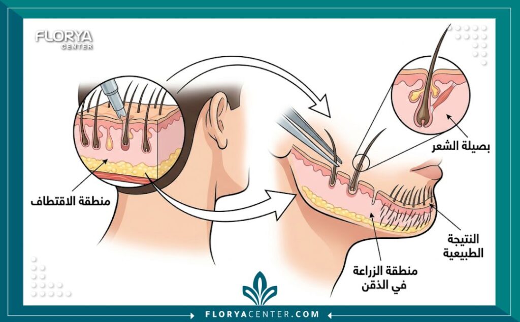رسم توضيحي طبي يشرح خطوات عملية زراعة شعر الذقن والشنب بتقنية FUE من الاقتطاف إلى الغرس