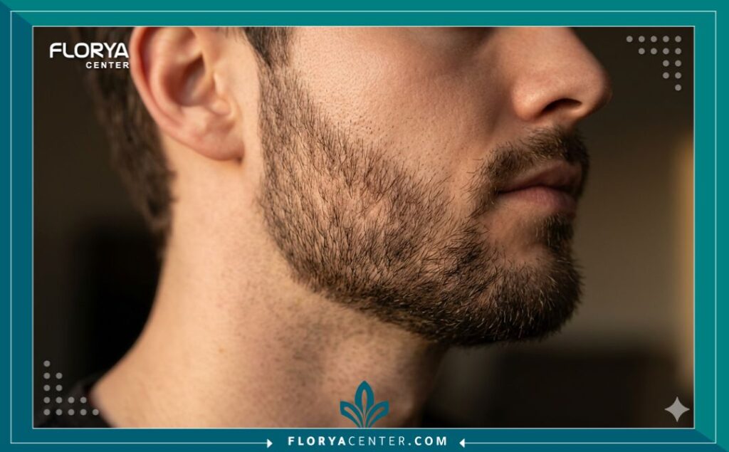 لقطة قريبة تظهر كثافة واتجاه نمو الشعر الطبيعي على تحديد الخد بعد نتائج و تجارب زراعة شعر اللحية والشنب.