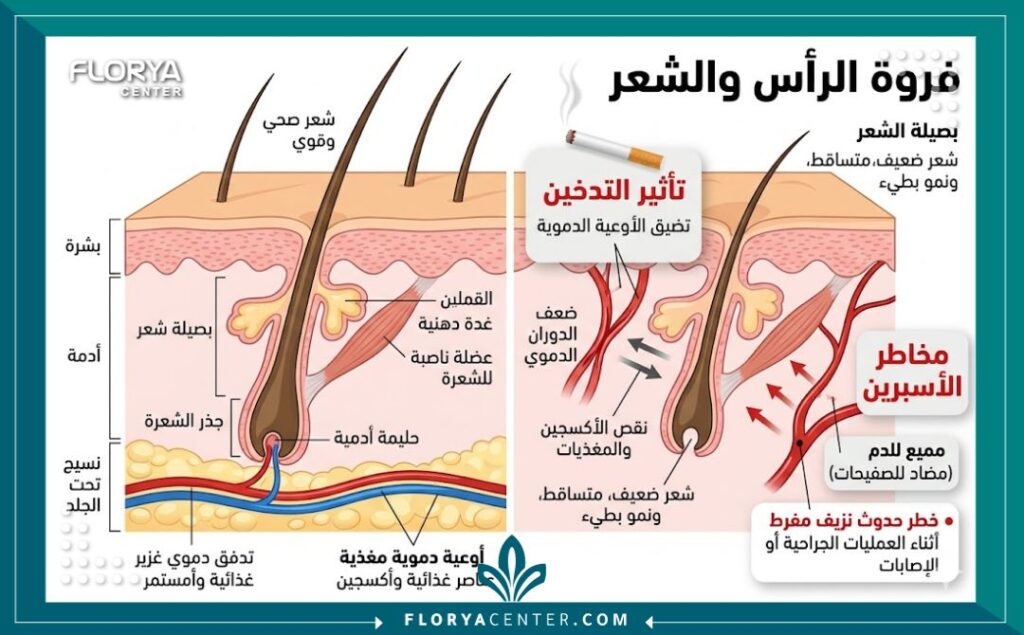 رسم توضيحي طبي لفروة الرأس يوضح تأثير التدخين والأسبرين على الدورة الدموية وبصيلات الشعر قبل عملية الزراعة، مع شرح باللغة العربية.