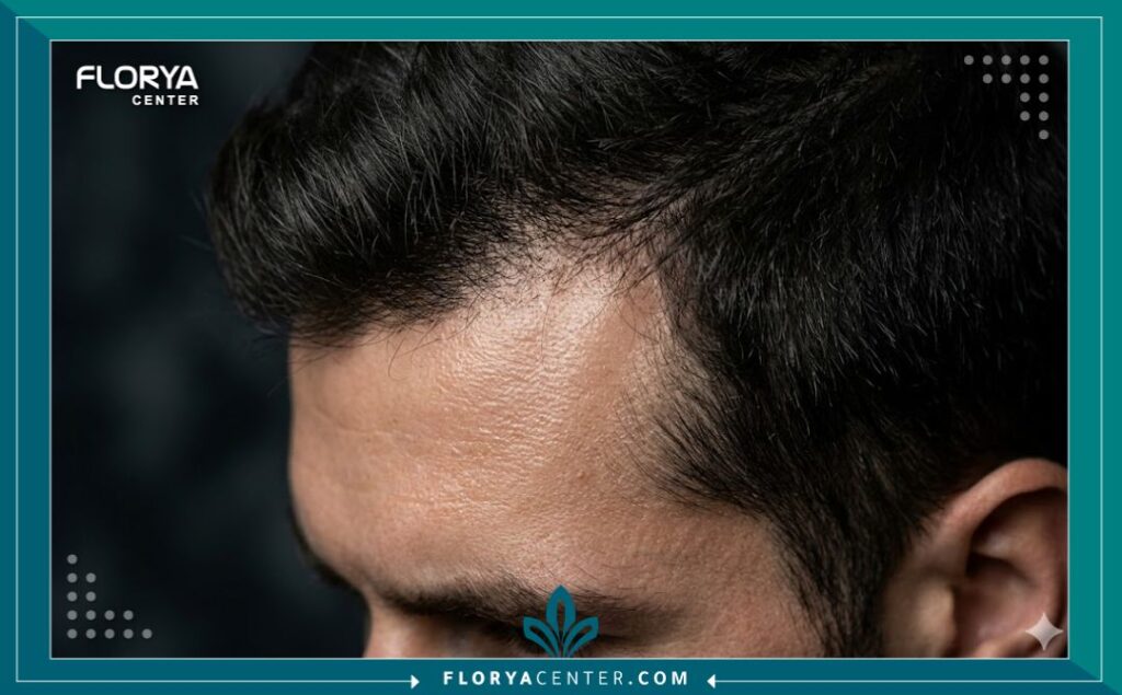 لقطة مقربة تظهر كثافة الشعر وصحة فروة الرأس عند منبت الشعر للرجال بعد العلاج.