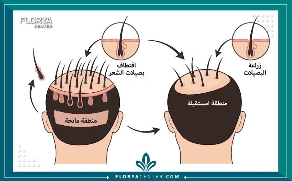 رسم توضيحي طبي لعملية زراعة الشعر بتقنية FUE، يُظهر اقتطاف البصيلات وزرعها في المنطقة المستقبلة.
