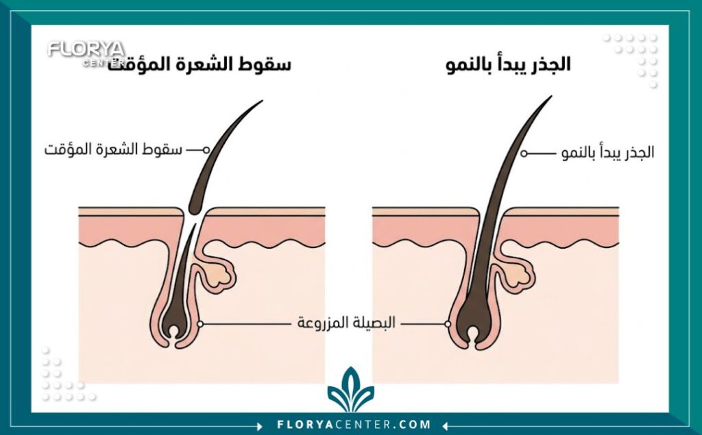 رسم تخطيطي طبي يوضح مرحلة "صدمة الفقدان" حيث تسقط الشعرة وتبقى البصيلة حية، مفسراً سبب هل يتساقط الشعر المزروع بعد الزراعة.