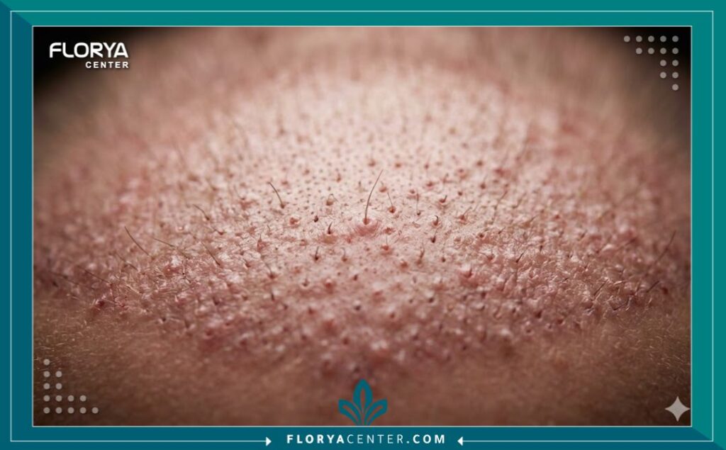 لقطة مكبرة لفروة الرأس بعد شهر من زراعة الشعر، تظهر تساقط الشعيرات المزروعة وبدء نمو شعيرات جديدة دقيقة.