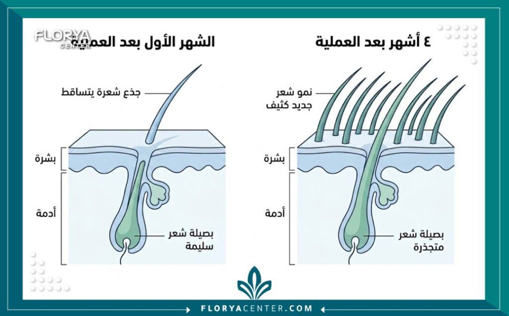 رسم بياني طبي يوضح الفرق بين تساقط ساق الشعر المزروع وبقاء البصيلة حية تحت الجلد لبدء دورة نمو جديدة.