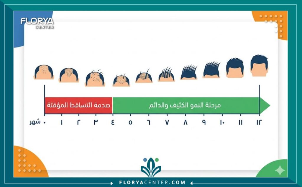 انفوجرافيك يوضح الجدول الزمني هل يتساقط الشعر المزروع المؤقت (صدمة التساقط) ومراحل النمو النهائي الدائم خلال السنة الأولى.
