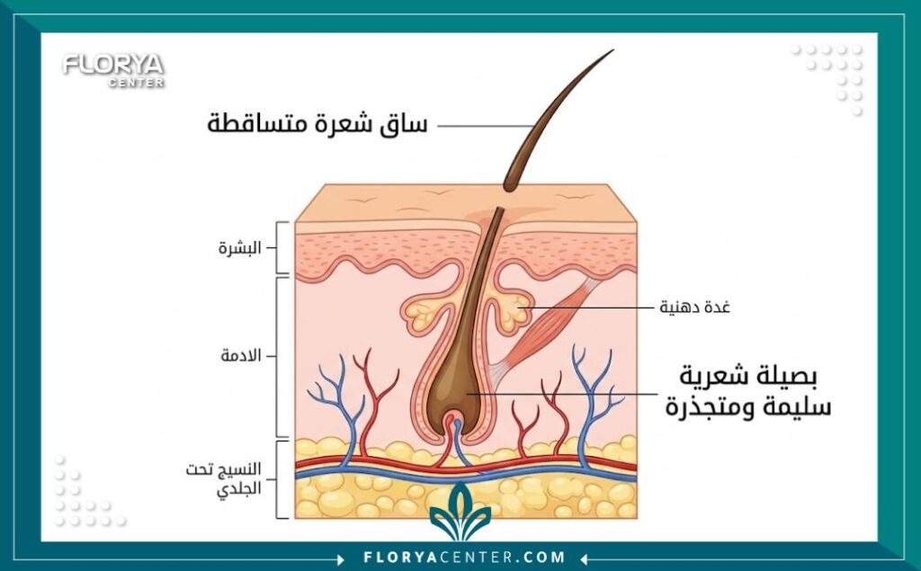 رسم توضيحي طبي يوضح تساقط ساق الشعرة فقط بينما تبقى بصيلة الشعر المزروعة ثابتة وآمنة تحت الجلد.