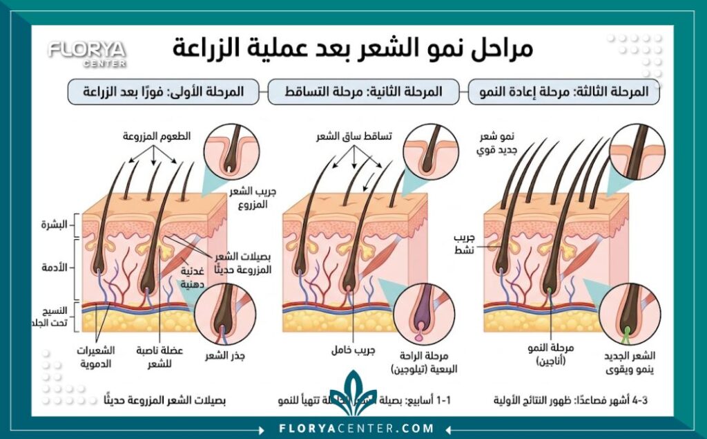 مخطط طبي يوضح مراحل بصيلات الشعر بعد الزراعة: مرحلة التثبيت، ثم مرحلة التساقط المؤقت (Shock Loss)، وأخيرًا مرحلة إعادة النمو.