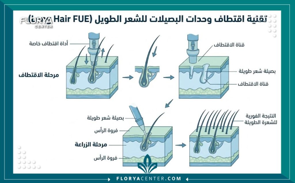 رسم تخطيطي طبي يوضح كيفية اقتطاف وزراعة بصيلات الشعر الطويل (Long Hair FUE) مع التسميات بالعربية.
