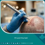 واجهة المقال: عملية زراعة الشعر بتقنية DHI باستخدام أقلام تشوي في عيادة متطورة.