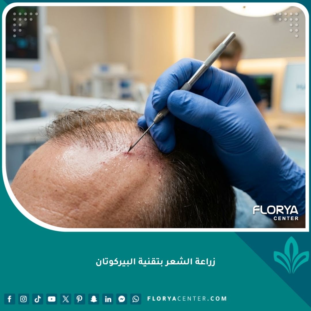 لقطة مكبرة احترافية تظهر طبيبًا يستخدم إبرة البيركوتان الدقيقة لزراعة بصيلة شعر واحدة في مقدمة الرأس بدقة عالية، مما يبرز تقنية زراعة الشعر بتقنية البيركوتان لنتائج طبيعية.