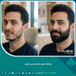 صورة قبل وبعد زراعة شعر الذقن تظهر النتائج الطبيعية والكثافة الجديدة.