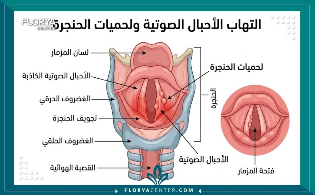 أسباب خشونة الصوت عند النساء 2 رسم تخطيطي طبي يوضح تشريح الحنجرة والأحبال الصوتية عند النساء مع تبيين مكان اللحميات كأحد أسباب خشونة الصوت.