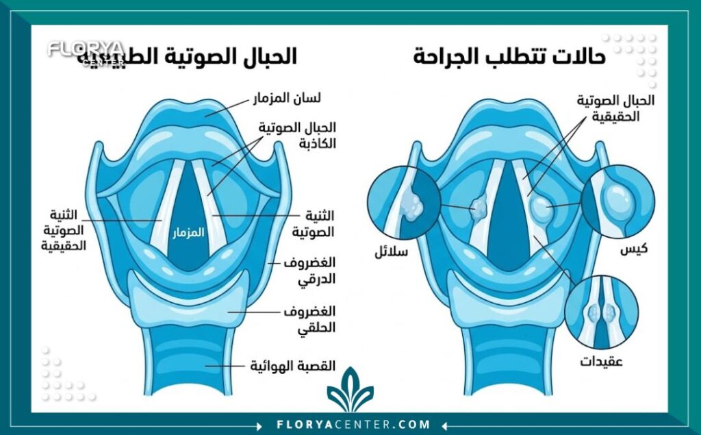 رسم تخطيطي طبي يوضح تشريح الحبال الصوتية والحالات التي تتطلب تدخلًا جراحيًا مثل السلائل والعقيدات.