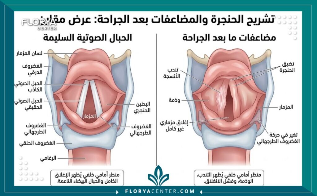 رسم تخطيطي طبي يوضح تشريح الحنجرة ومضاعفات عملية تجميل الصوت مثل التندب والالتهاب
