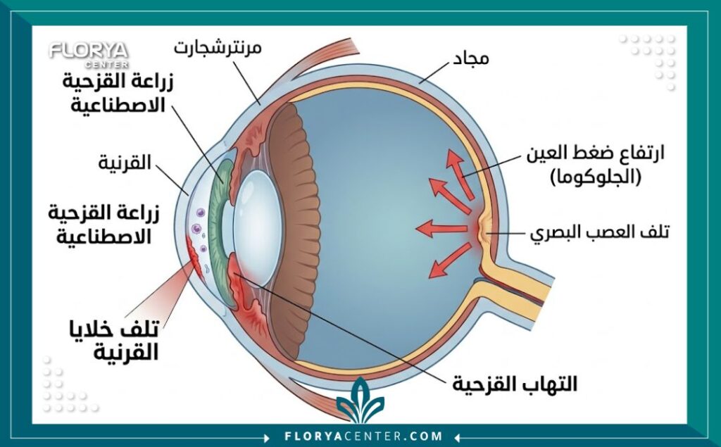 مخطط تشريحي طبي لزرع القزحية الاصطناعية، يوضح مضاعفات مثل الجلوكوما والتهاب القزحية باللغة العربية.