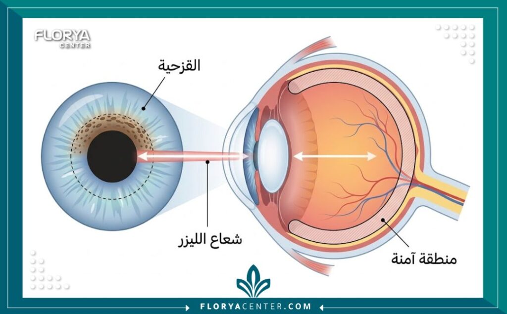 رسم توضيحي طبي يشرح آلية عمل ليزر تغيير لون العين بأمان دون التأثير على الرؤية.