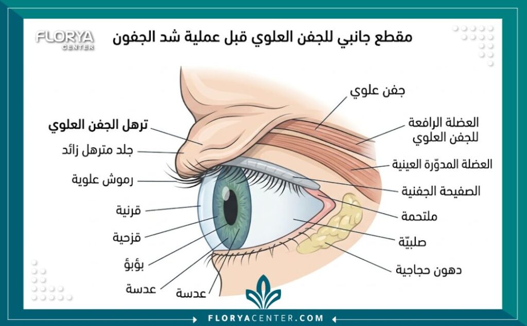 رسم طبي دقيق يوضح سبب اللجوء لعملية الجفن العلوي وتأثير الجلد المترهل والمتدلي على الرموش ومجال الرؤية