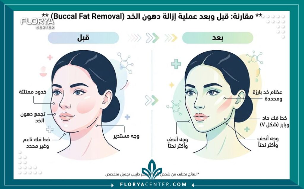 استئصال الدهون الفموية جراحياً 3 إنفوجرافيك يوضح الفرق بين الوجه الدائري الممتلئ والوجه المنحوت قبل وبعد عملية إزالة دهون الخد.