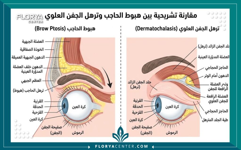 رسم توضيحي طبي يوضح التشريح العضلي للفرق بين ترهل الجفون العلوية وهبوط الحواجب.