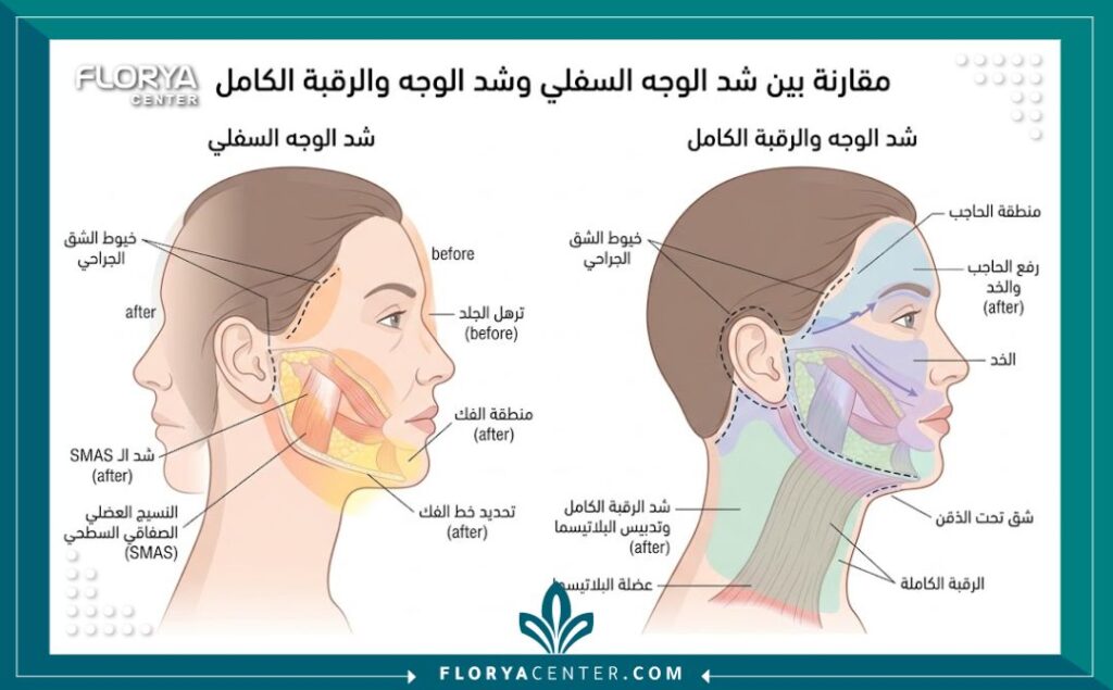 الفرق بين شد الوجه المصغر والكامل 2 رسم طبي يوضح خطوط الندبة الجراحية ومناطق الشد في الفرق بين شد الوجه المصغر والكامل.