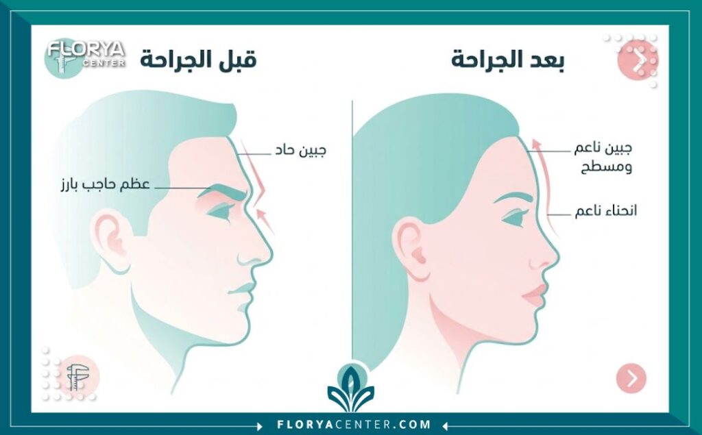إنفوجرافيك يقارن بين شكل الجبهة قبل وبعد عملية برد عظمة الجبهة لتنعيم الملامح الذكورية.