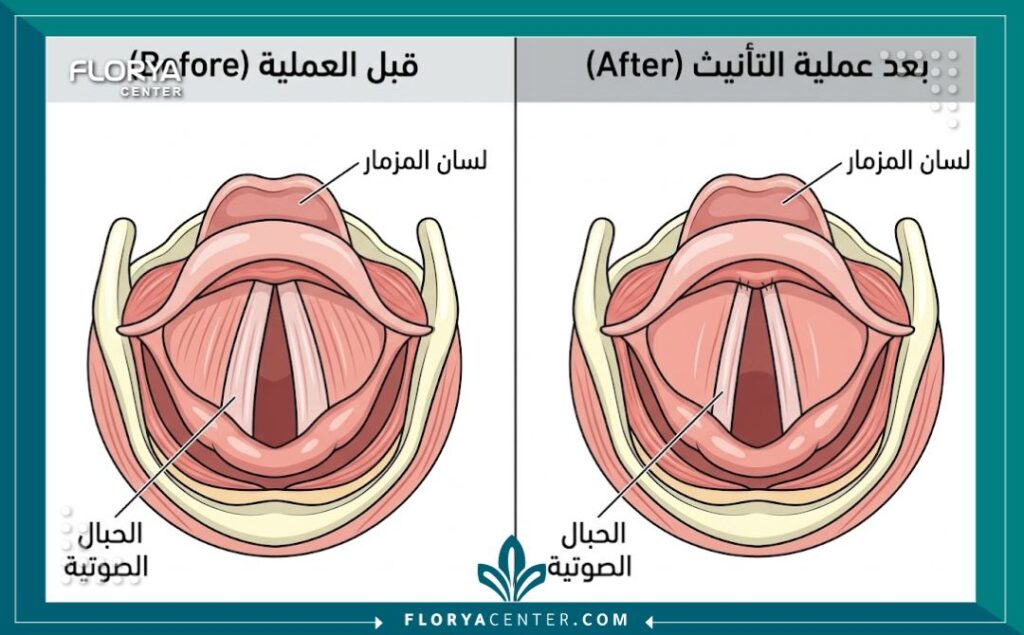 تأنيث الصوت للمتحولين في تركيا 2 رسم تخطيطي طبي يوضح الفرق في تشريح الحنجرة والحبال الصوتية قبل وبعد عملية جراحة تأنيث الصوت للمتحولين.