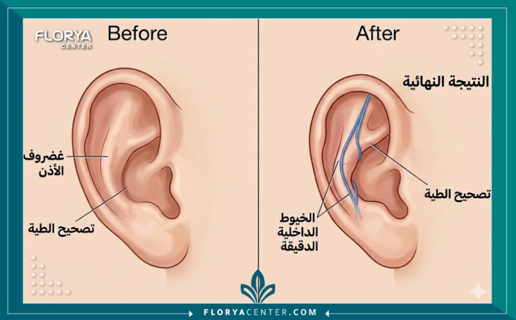 رسم تخطيطي طبي يوضح كيفية زراعة الخيوط الداخلية في غضروف الأذن لطيها وتصحيح بروز الأذن الخفاشية بدون شق جراحي.