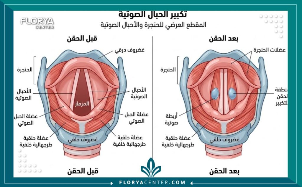 رسم تخطيطي طبي يوضح تشريح الحنجرة وموضع حقن تجميل الأحبال الصوتية.