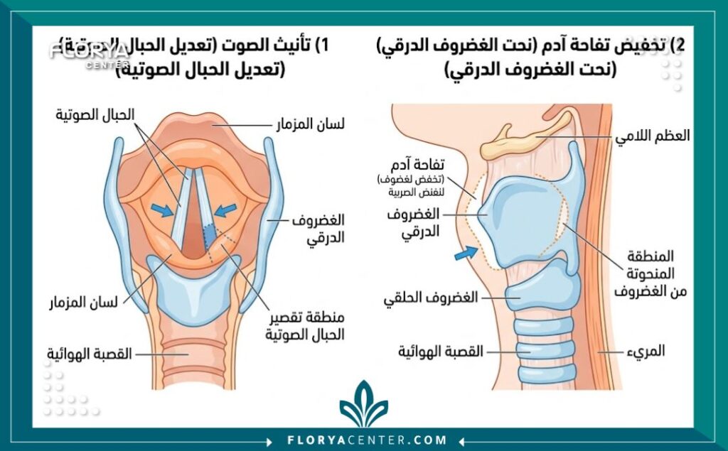 رسم تخطيطي طبي يوضح تشريح الحنجرة وعمليات تجميل الصوت وتصغير تفاحة آدم في تركيا.
