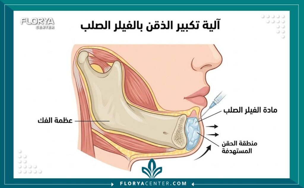 رسم تخطيطي طبي يوضح تشريح الذقن وكيفية حقن الفيلر الصلب فوق العظم مباشرة لتطويل الوجه وتصحيح التراجع.