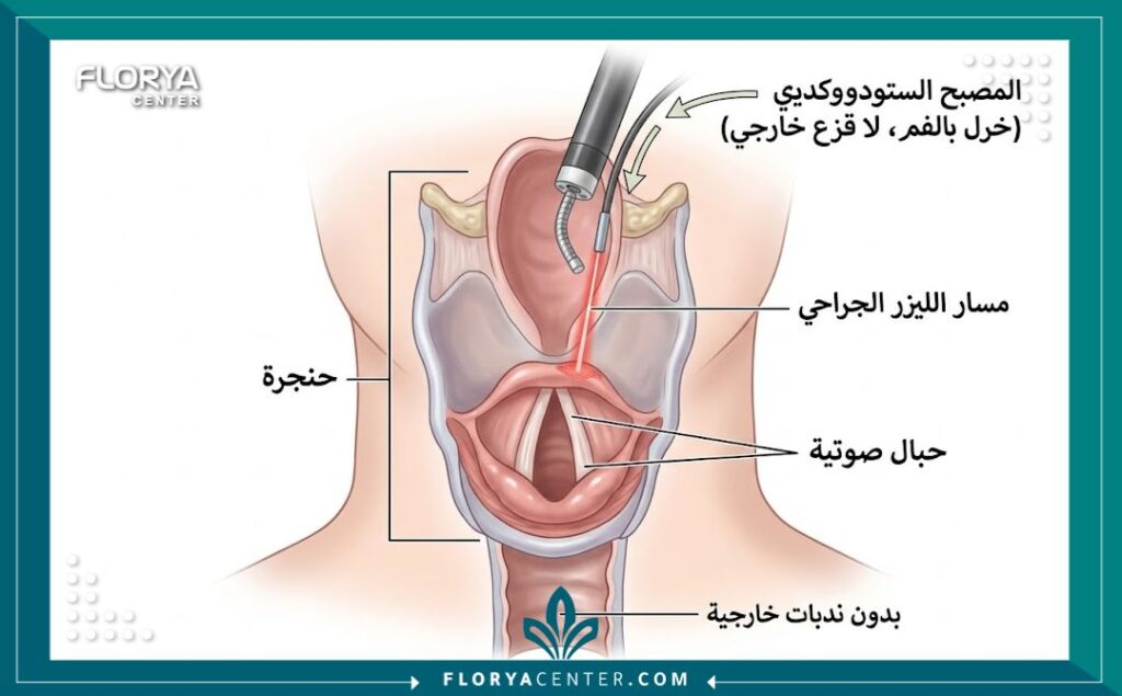 رسم تخطيطي طبي يوضح تشريح الحنجرة وكيفية عمل الليزر الجراحي لتعديل الصوت بدون جروح خارجية.