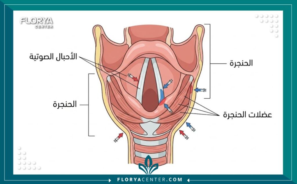 مخطط طبي يوضح تشريح الحنجرة والأحبال الصوتية والمناطق المستهدفة في عملية تحسين الصوت غير الجراحية.