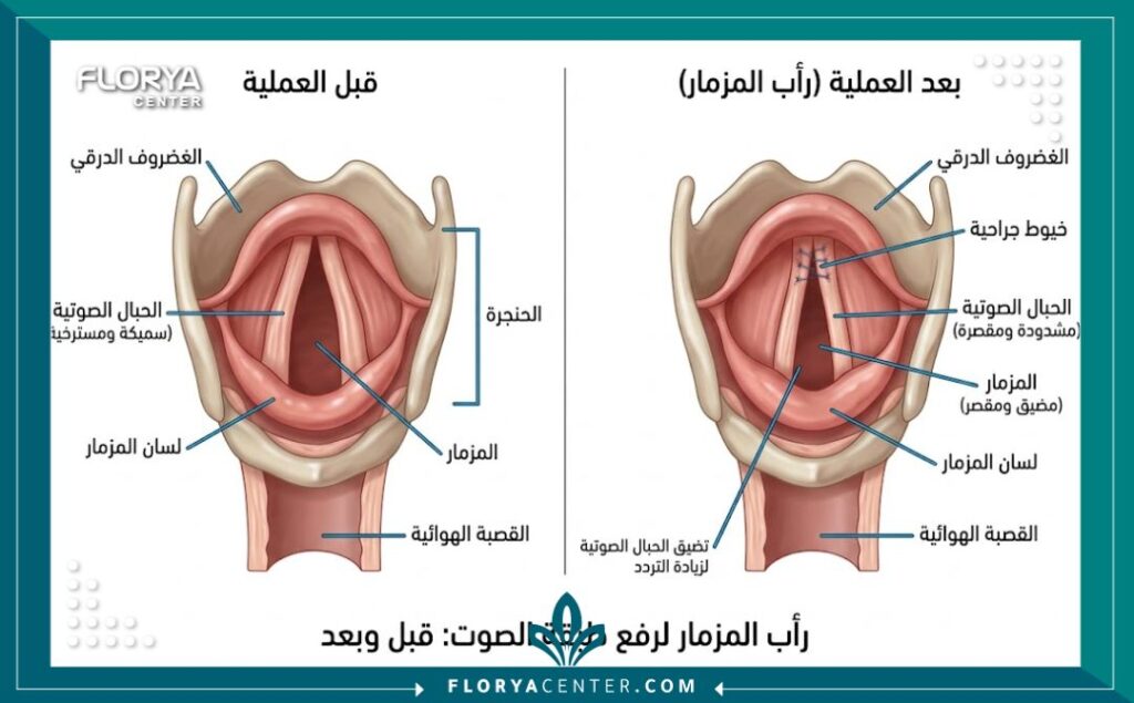 رسم تخطيطي طبي يوضح عملية تقصير الحبال الصوتية لرفع طبقة الصوت للنساء في تركيا.