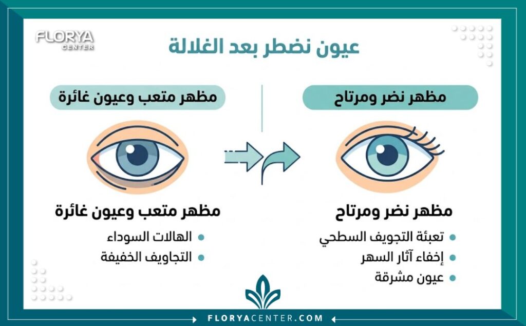 إنفوجرافيك يوضح فوائد تجميل زوايا العين بالفيلر السطحي