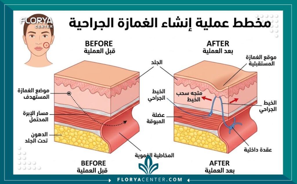 رسم تخطيطي طبي يوضح كيفية عمل الغمازة عن طريق ربط الجلد بالعضلة باستخدام الخيط الجراحي البسيط داخل الخد.