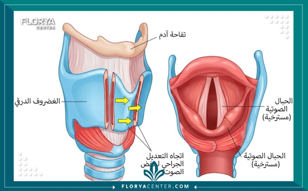 مخطط طبي تشريحي يوضح كيفية إجراء جراحة تخشين الصوت (Thyroplasty) وتعديل الحبال الصوتية لخفض الطبقة الصوتية.