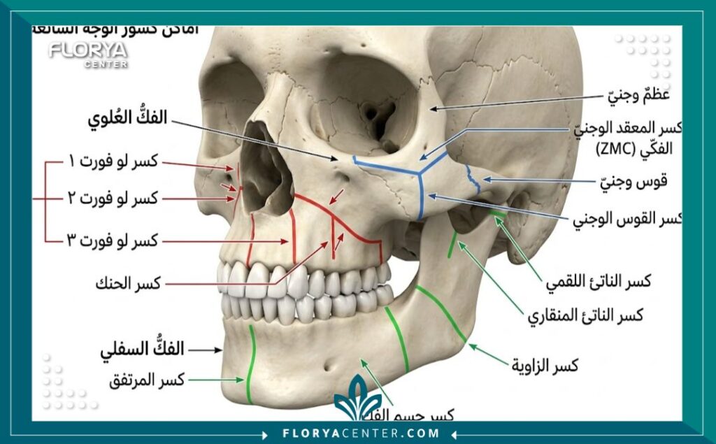 ترميم كسور عظام الوجه الجمالية 2 رسم تخطيطي طبي يوضح مواقع كسور عظام الوجه الشائعة في الخد والفك والأنف التي تتطلب ترميمًا جماليًا.