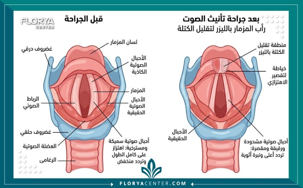 رسم تخطيطي طبي يوضح الفرق في شكل الحبال الصوتية قبل وبعد جراحة تغيير الصوت في تركيا، توضح نية البحث عن الحل الجذري التجميلي.