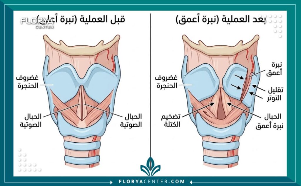 مخطط طبي يوضح تشريح الحنجرة والحبال الصوتية وكيفية تعديلها جراحياً لزيادة ضخامتها وتخشين الصوت للذكور في عيادات تركيا.